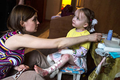 Каллиста Кудрявцева, 3 года, врожденный буллезный эпидермолиз, требуется лечение. 529 210 руб.